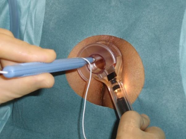 Detekce arterií ultrazvukovou sondou